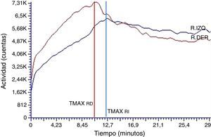 Curva renográfica postadministración de MCI. Alteración del patrón normal por retraso al valor pico de las curvas (TMAX alargado) y sostenimiento de la etapa de eliminación (T50%Mx >30).