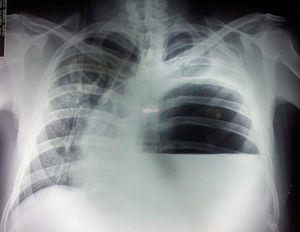 Radiografía de tórax sugestiva de derrame pleural.
