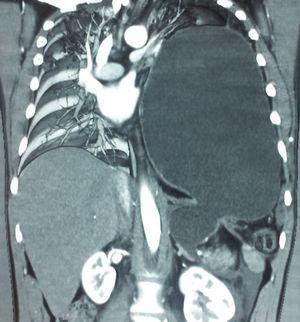 Tomografía de tórax contrastada en corte coronal. Muestra el defecto en diafragma y el estómago en toda la cavidad torácica izquierda.