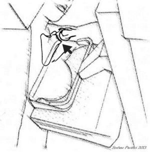 El ángulo superior de la pala del compresor debe comprimir lo más cerca de la articulación escapulo-humeral.