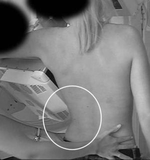La cadera de la mujer debe quedarse por detrás del margen antero-inferior del detector.