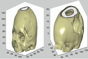 Representación de la reconstrucción 3D de tejido óseo.