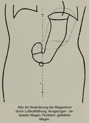 Representación de la posición natural del estómago en bipedestación. En línea punteada, la posición morfológicamente alterada que adopta con el llenado de aire (Groedel FM. Atlas und Grundriss der Röntgendiagnostik in der inneren Medizin. München: JF Lehmann