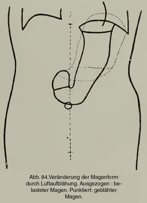 Representación de la posición natural del estómago en bipedestación. En línea punteada, la posición morfológicamente alterada que adopta con el llenado de aire (Groedel FM. Atlas und Grundriss der Röntgendiagnostik in der inneren Medizin. München: JF Lehmann's Verlag; 1909. p. 191).