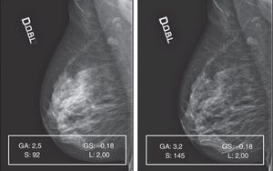 La elaboración de 17 de los 22 mamogramas con patrón 3 se reveló muy complicada por el repentino detrimento de la calidad y la pérdida de detalles anatómicos.