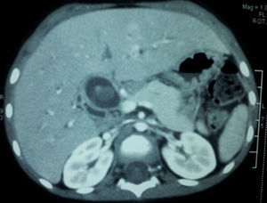 Tomografía contrastada de abdomen. Se observa tríada portal, páncreas con ligero aumento de tamaño.