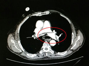 Corte de tomografía axial en la que se observa tromboembolismo pulmonar con imagen «en silla de montar».