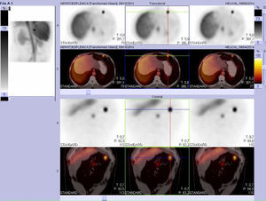 Fusión de imagen SPECT con la TC previa, que permite identificar y correlacionar los implantes esplénicos sin las imágenes nodulares.