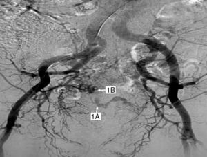 1A: Extravasación intraluminal de contraste en rama, dependiente de la arteria hipogástrica derecha. 1B: Signos indirectos de sangrado: ovillo vascular, aumento de la trama capilar e hiperplasia capilar.