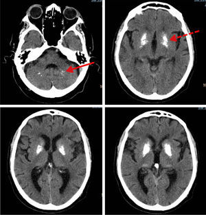 Calcificaciones de áreas cerebrales en los ganglios de la base núcleos pálido y putamen (flecha discontinua) y en el cerebelo (flecha continua).