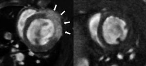 Realce miocárdico en un modelo de infarto frente al estudio basal. En la imagen de izquierda, secuencia de realce tardío con gadolinio de un modelo de infarto. Las flechas blancas indican el área del ventrículo izquierdo donde existe fibrosis. A la derecha, la misma secuencia en un estudio basal.
