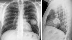 La radiografía simple en PA y perfil de tórax nos muestra una gran masa redondeada en el lóbulo medio izquierdo, bien definida, densa y de características aparentemente benignas.