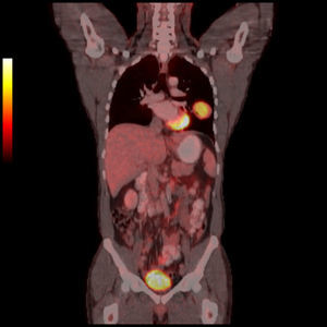 Las imágenes PET-TC coronales de fusión muestran la captación de fluorodesoxiglucosa en el organismo