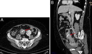 A) TC abdominal corte axial, se aprecian signos inflamatorios de la pared del colon sigmoide con afectación de la grasa mesentérica pericólica adyacente. B) TC abdominal corte sagital, presencia de cuerpo extraño de alta densidad en la luz del colon sigmoide.