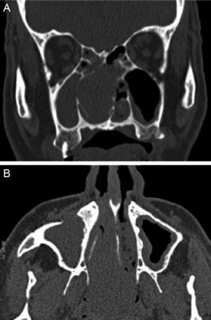 Imágenes de TC en planos coronal (A) y axial (B) que muestran una tumoración nasal derecha expansiva, que adelgaza la pared medial del seno maxilar derecho.