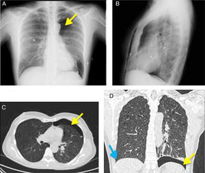 A y B) Radiografía simple de tórax PA y lateral que muestra neumotórax izquierdo (flecha en A) y afectación intersticial difusa. C y D) TC axial y coronal con ventana de pulmón en el que es evidente la presencia de quistes pequeños y redondos que afectan a todo el parénquima pulmonar sin preservar los senos costofrénicos (flecha izquierda en D).