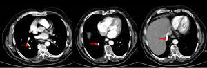 TC torácica tras la administración de CIV, 3 imágenes axiales en diferentes niveles que nos muestran el recorrido de este vaso anómalo en el hemitórax derecho hasta su desembocadura en la vena cava inferior. Es hiperdenso por la presencia de contraste intravenoso en su interior.