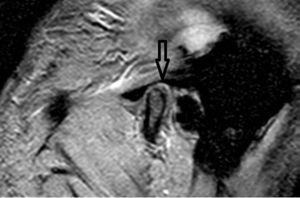 Boca cerrada. La imagen evidencia el disco articular posicionado posteriormente al cóndilo mandibular.