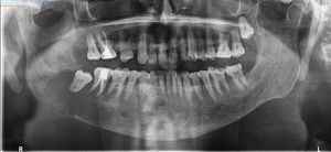 En la ortopantomografía se evidencia una gran lesión osteolítica en el 4 cuadrante mandíbula.