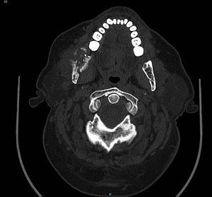 En la imágenes TAC se evidencia una gran destrucción ósea en 4 cuadrante mandibular. La lesión no afecta los tejidos blandos perimandibulares.