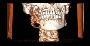 Reconstrucción 3D. La lesión se extiende desde el primer premolar hasta la región subcondilea.