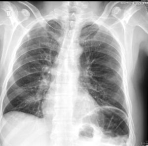 Radiografía PA de tórax en donde se aprecia asa de colon en ángulo esplénico con desplazamiento superior del hemidiafragma izquierdo (signo de Chilaiditi izquierdo).