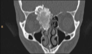 TC de senos paranasales, corte coronal. Masa heterogéneamente densa de 46mm de longitud craneocaudal, invade celdas etmoidales derechas y la parte medial de la órbita adyacente.