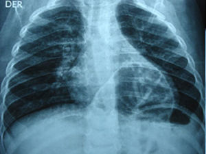 Thoracic X-ray with preoperatorative Morgagni's hernia.
