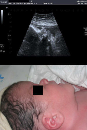 Perfil acondroplasia: plano sagital medio de cara fetal (6a); perfil del recién nacido (6b).