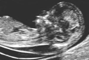 Imagen ecográfica de un feto de 12 semanas con síndrome de Down, en la que se muestra un aumento de la translucencia nucal.
