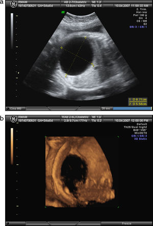 Ecografia 2D (a) e 3D (b), às 34 semanas, mostrando quisto do ovário de 6,7×5,5cm, antes da aspiração.