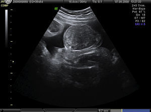 Parece identificarse pequeñas imágenes econegativas que corresponden a las asas intestinales (36 semanas).
