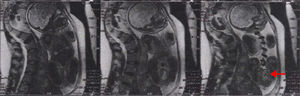Imagen de la resonancia magnética prenatal.