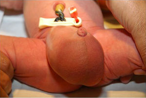 Aspecto de los genitales en el neonato.