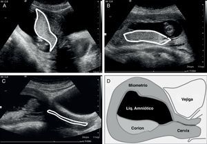 Valoración ecográfica inicial transabdominal. A) sagital medio, define corion anterior o posterior. B) transversal, define lateralidad: derecho, izquierdo o central. C) sagital del cérvix, define canal endocervical. D) esquema que muestra corion de localización posterior.