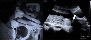 Avance de la pinza hasta el orificio cervical interno mediante control ecográfico continuo por parte del ayudante ecografista (flecha).