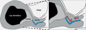 Trayecto canal cervical en forma de «J». Las flechas muestran el movimiento que debe realizarse durante la introducción de la pinza hasta el orificio cervical interno.