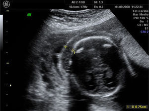 Edema subcutáneo, primer feto afecto.