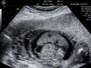 Ascitis, primer feto afecto.