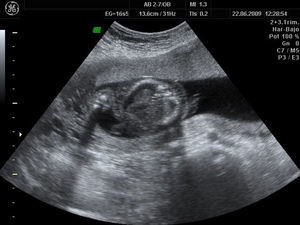 Ascitis, segundo feto afecto.