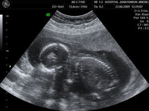 Edema subcutáneo, segundo feto afecto.
