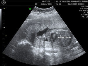 Hidrotórax, segundo feto afecto.