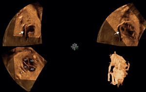 Reconstrucción multiplanar con el punto de intersección situado en el colector (flecha recta). La renderización está hecha en modo inverso. El colector se visualiza entre la vena cava inferior y la aorta.