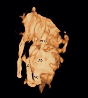 Reconstrucción 3D en modo inverso: vista dorsal del corazón y los grandes vasos, con rotación un poco a la derecha. Se visualiza el colector entre la vena cava inferior y la aurícula derecha por un lado y la arteria aorta por otro.
