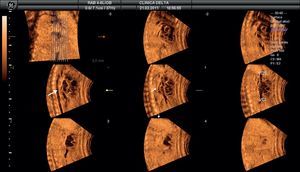 Tomographic ultrasound imaging con secuencia de imágenes paralelas en corte longitudinal que se desplazan de izquierda a derecha sobre el tórax fetal. El punto de referencia está situado en el colector (flecha recta). En las tres imágenes del centro podemos observar, de dorsal a ventral y de izquierda a derecha en el feto, la aorta (flecha curva), el colector y el eje de cavas.