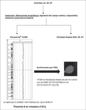 Ejemplo del uso del Karyoarray® 8x60K en el PI de muestras de fetos con malformaciones ecográficas y cariotipo normal. PI:proyecto de Investigación.