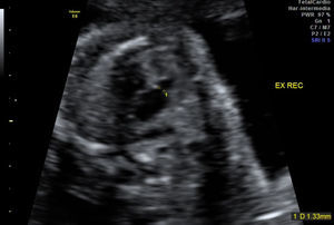 Estenosis pulmonar: imagen ecocardiográfica prenatal en la que se identifica tracto de salida de ventrículo derecho de calibre reducido y válvula pulmonar hiperecogénica.