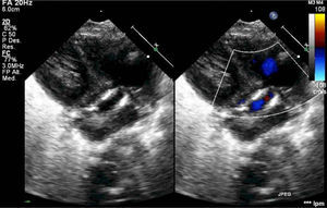 Estenosis pulmonar supravalvular con calcificación de la raíz de la válvula pulmonar en ecocardiografía postnatal.