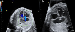 Corte de 4 cámaras apical: a) signos de insuficiencia tricuspídea al aplicar el doppler color. b) cardiomegalia e hipertrofia miocárdica.