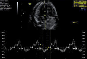 Medición del índice de Tei en ventrículo izquierdo: corte de 5 cámaras apical con el volumen muestra del doppler pulsado entre la válvula mitral y la aórtica.